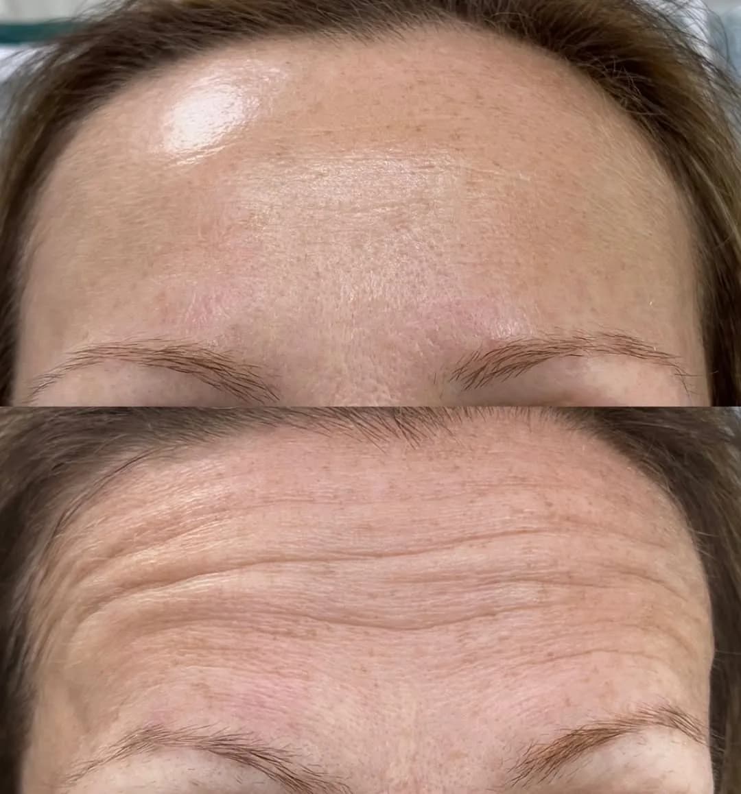 Wypełnianie zmarszczek – zabieg wykonywany w Biała Podlaska