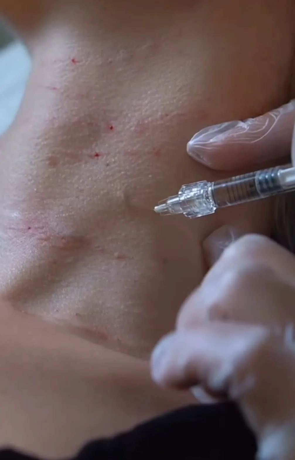 Stymulatory tkankowe – zabieg wykonywany w Biała Podlaska