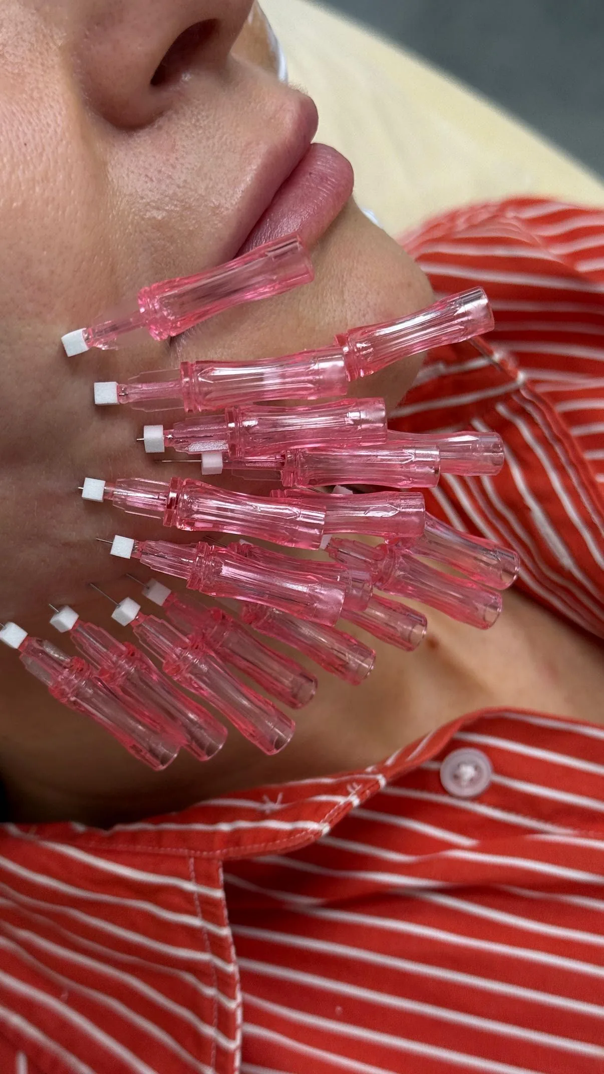 Nici PDO – zabieg wykonywany w Biała Podlaska