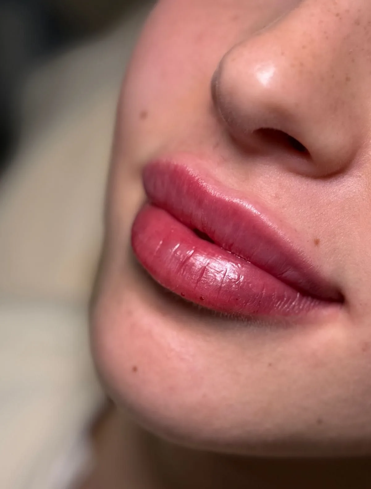 Powiększanie ust 1ml – zabieg wykonywany w Biała Podlaska