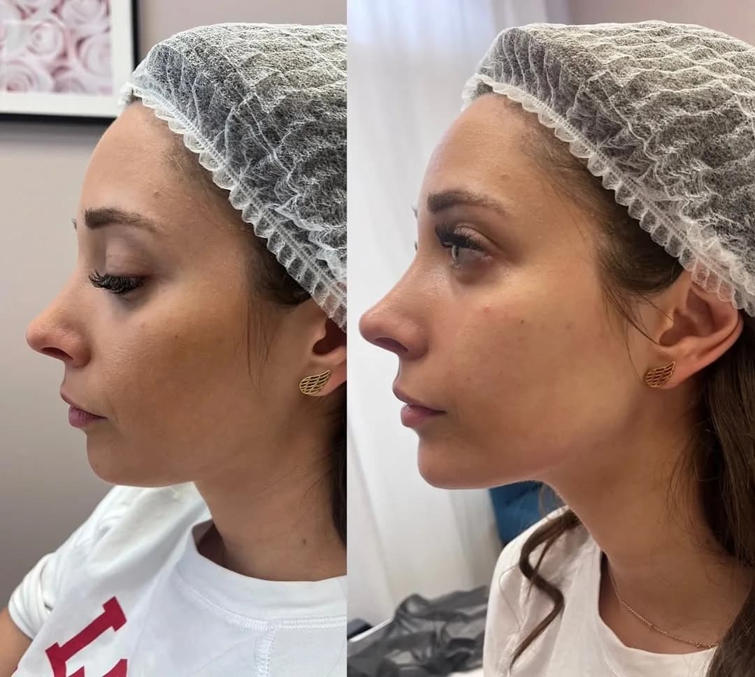 Wolumetria – zabieg wykonywany w Biała Podlaska