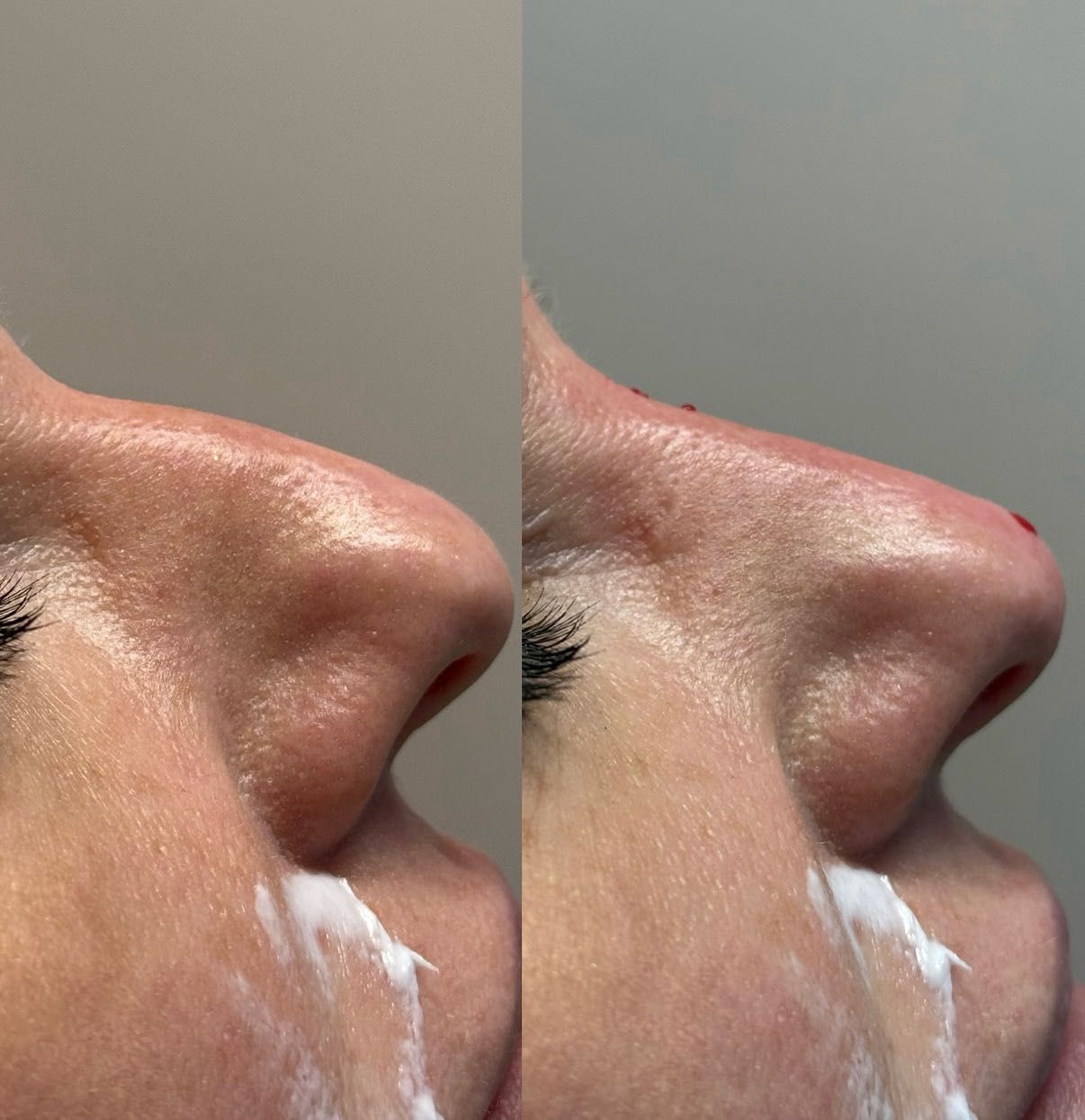 Wygładzenie zmarszczek - efekt przed i po zabiegu