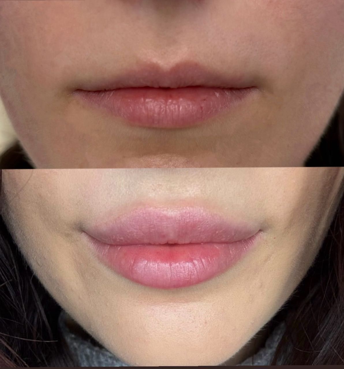 Efekt zabiegu: Naturalne powiększenie