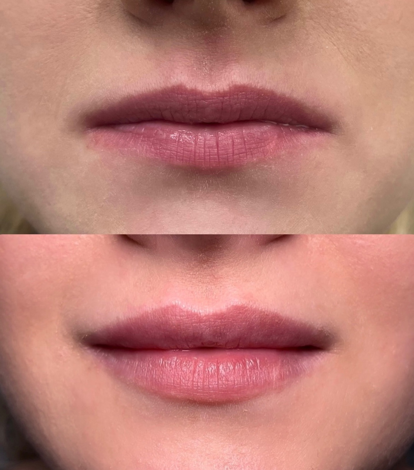 Harmonijne usta - efekt przed i po zabiegu