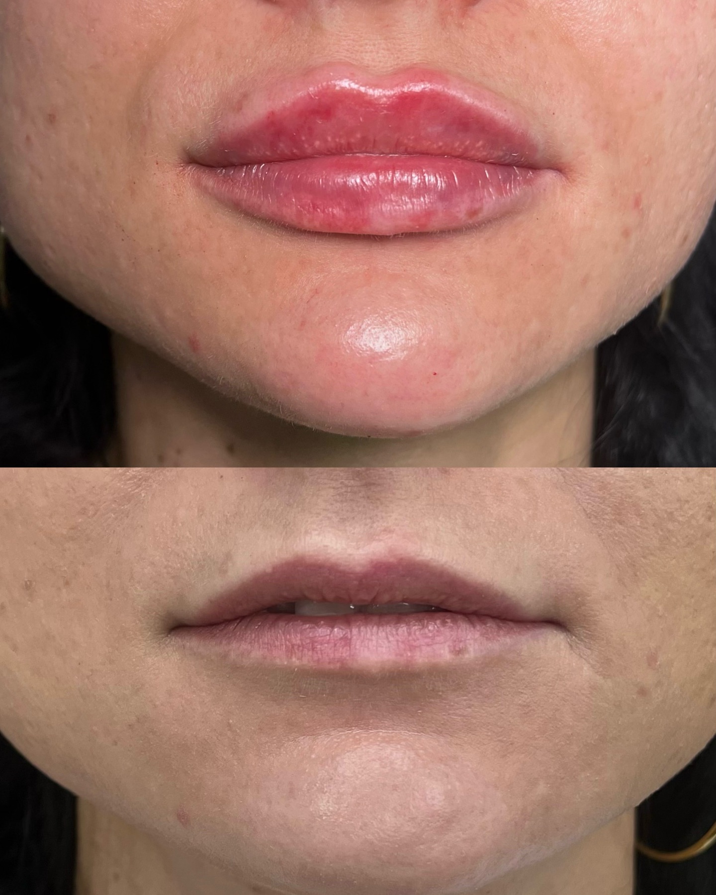 Modelowanie ust - wariant 2 - efekt przed i po zabiegu