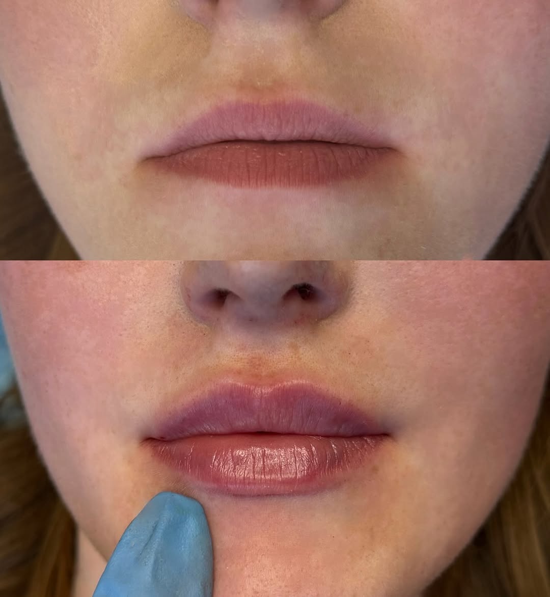 Naturalne powiększenie - efekt przed i po zabiegu