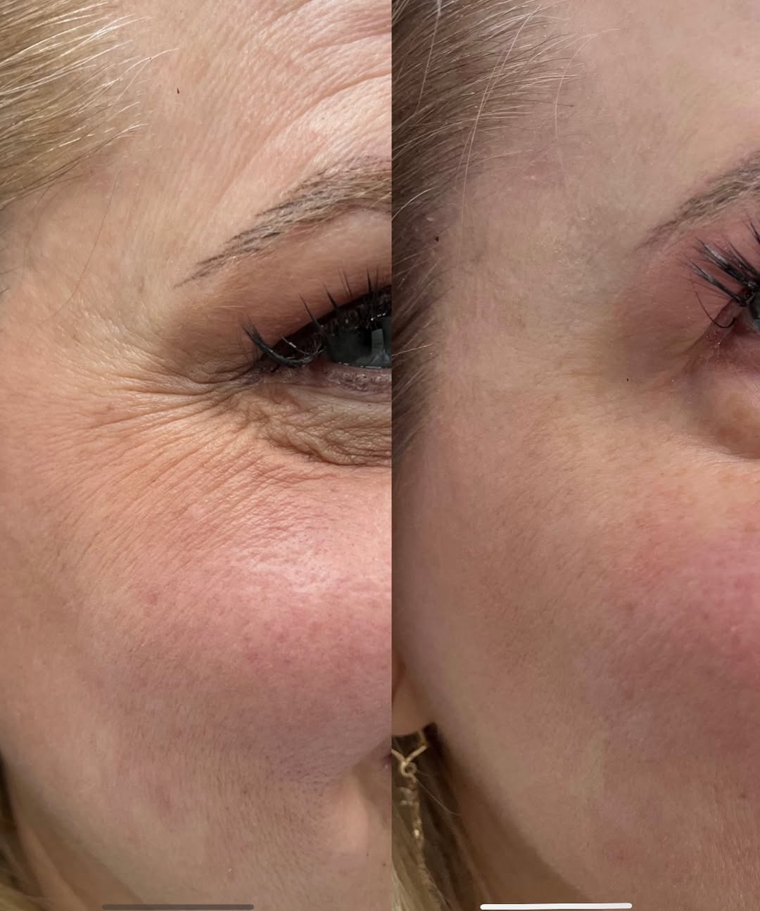 Efekt zabiegu: Niwelacja zmarszczek