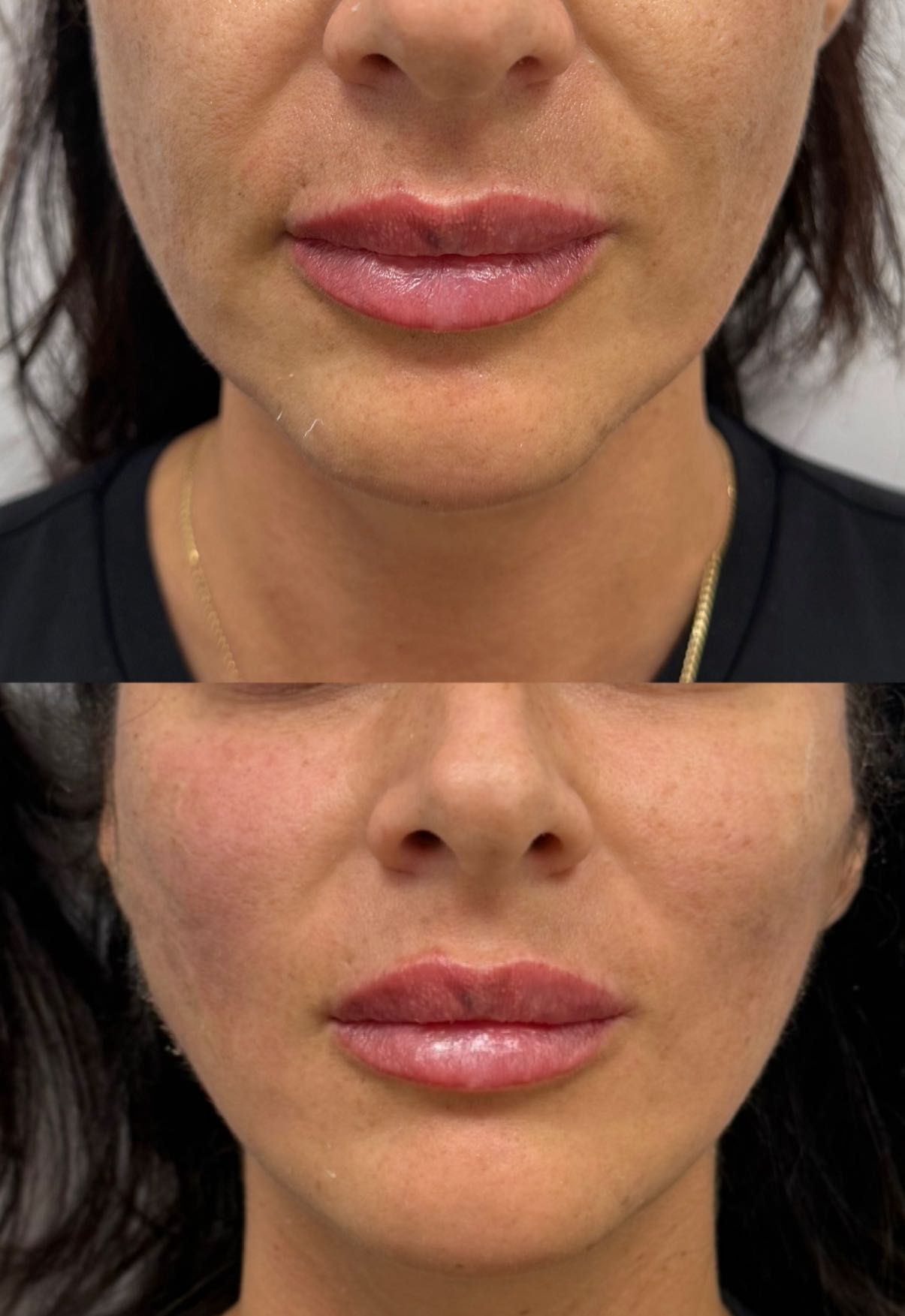 Efekt zabiegu: Korekta brody