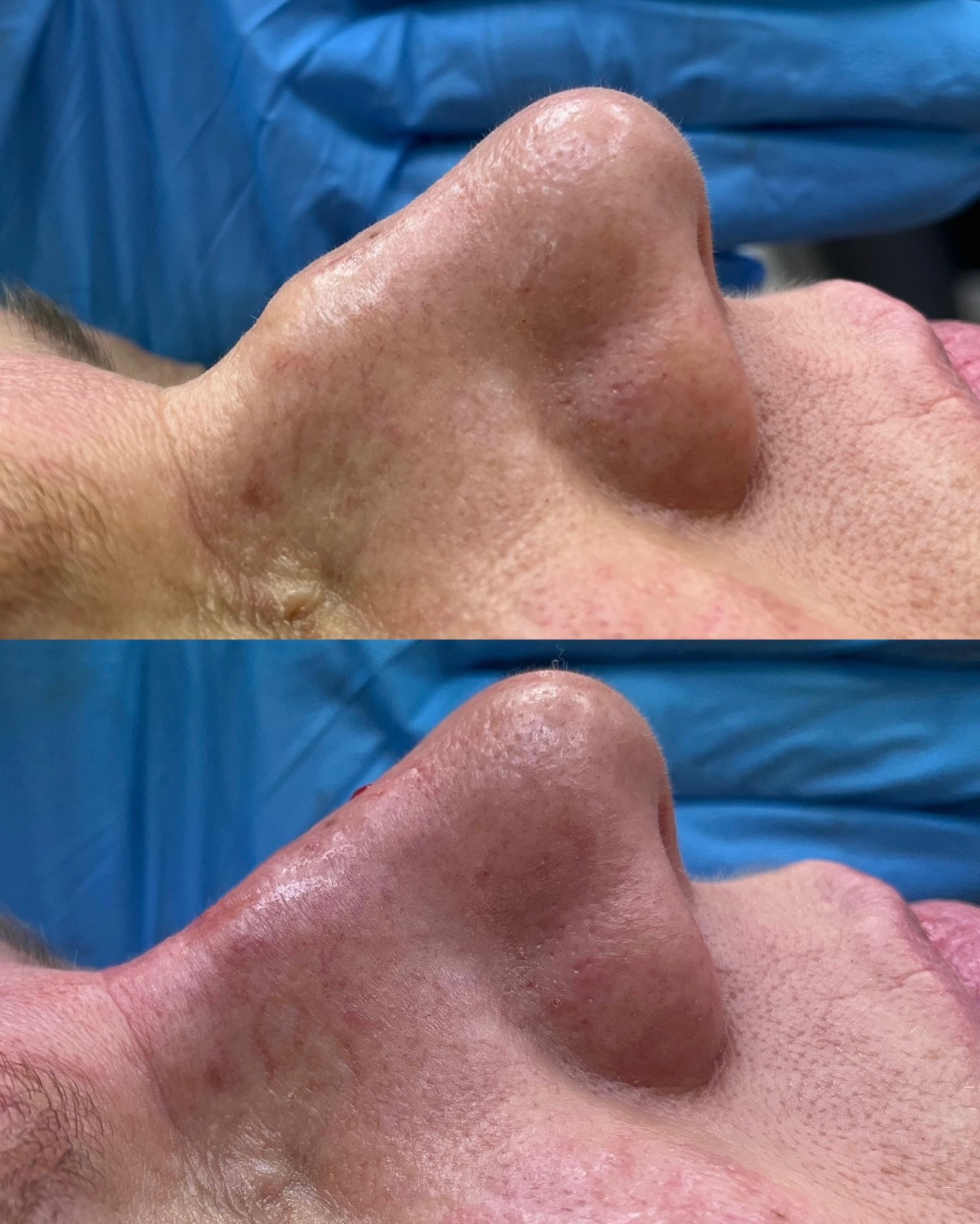 Korekta nosa - efekt przed i po zabiegu