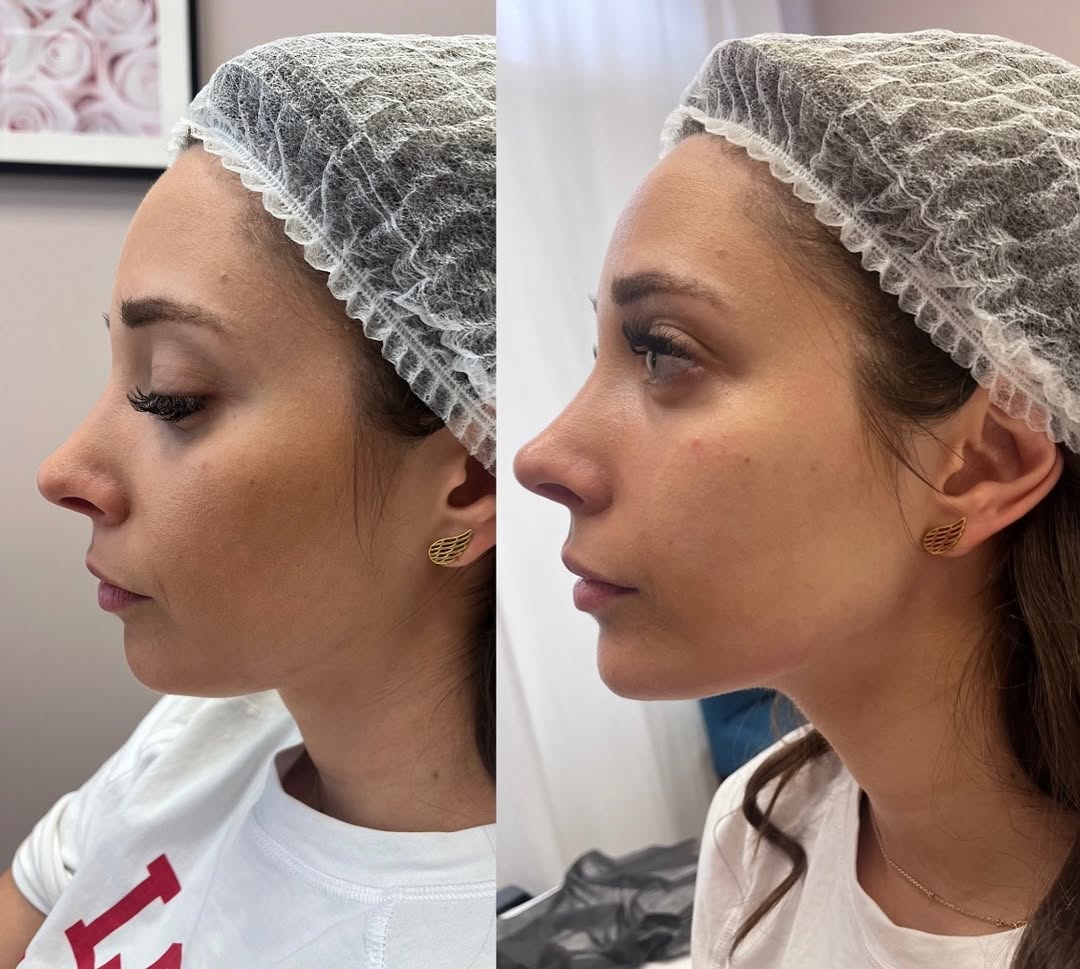 Definicja żuchwy - efekt przed i po zabiegu