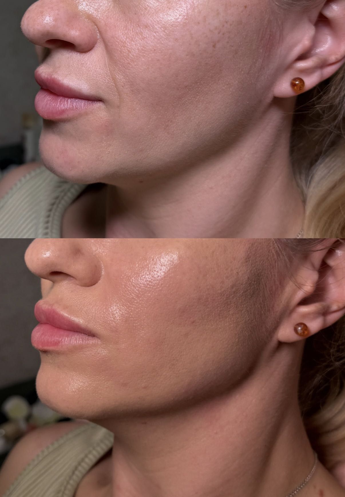 Rzeźbienie żuchwy - efekt przed i po zabiegu