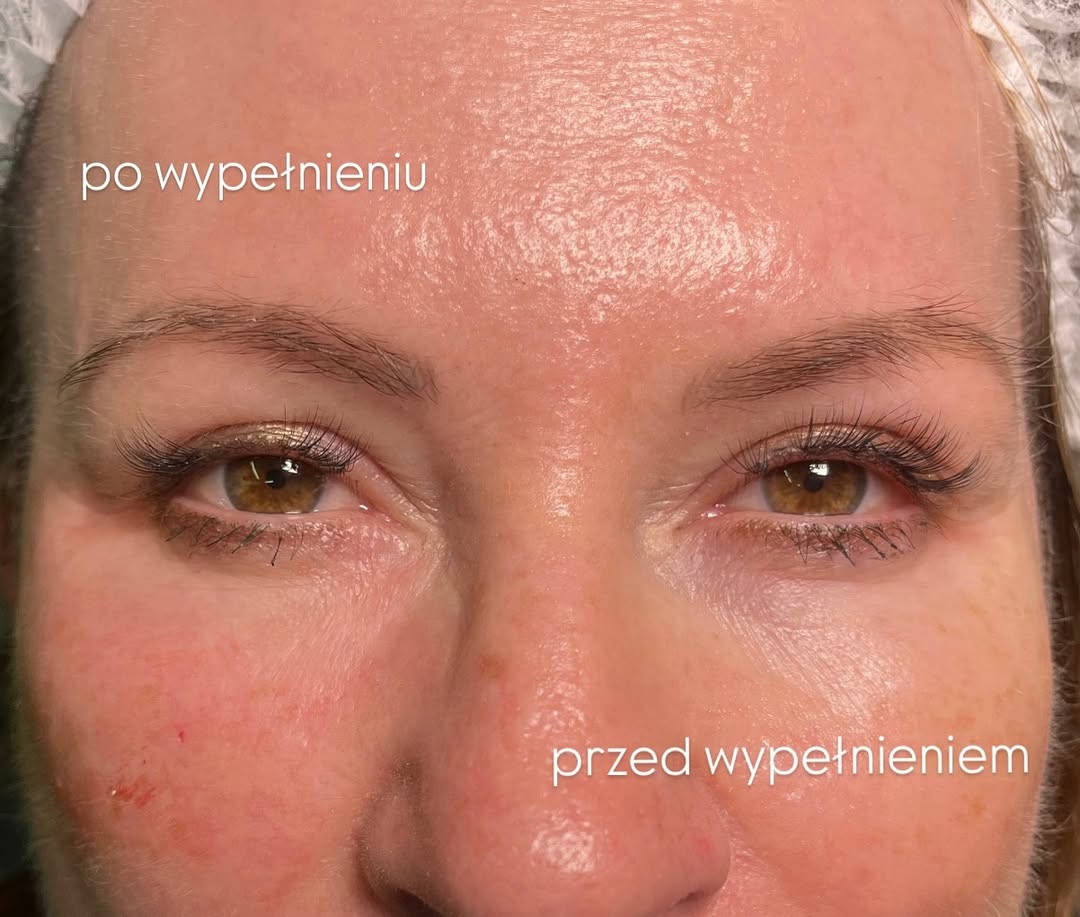 Korekta dolin łez - efekt przed i po zabiegu