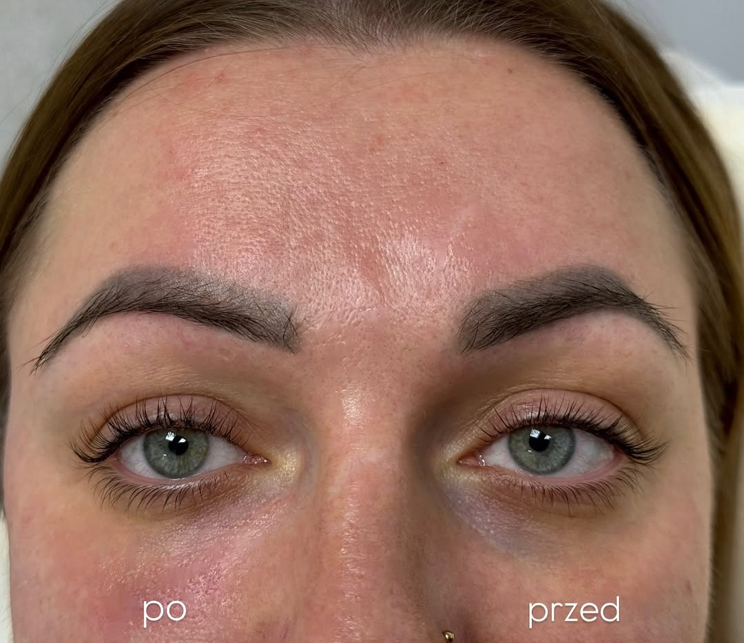 Wypełnienie doliny łez - efekt przed i po zabiegu